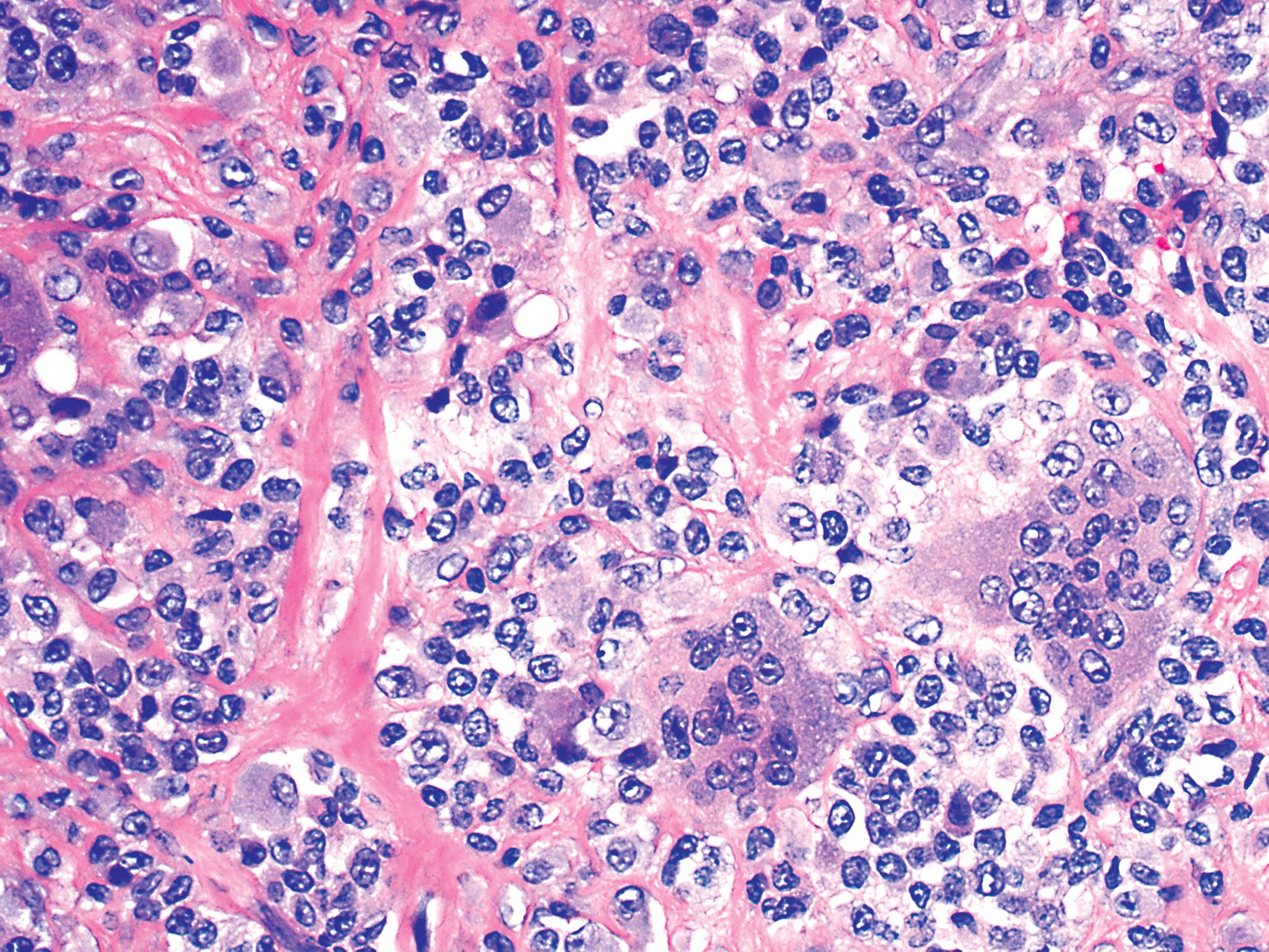 Pathology Outlines Giant cell granuloma